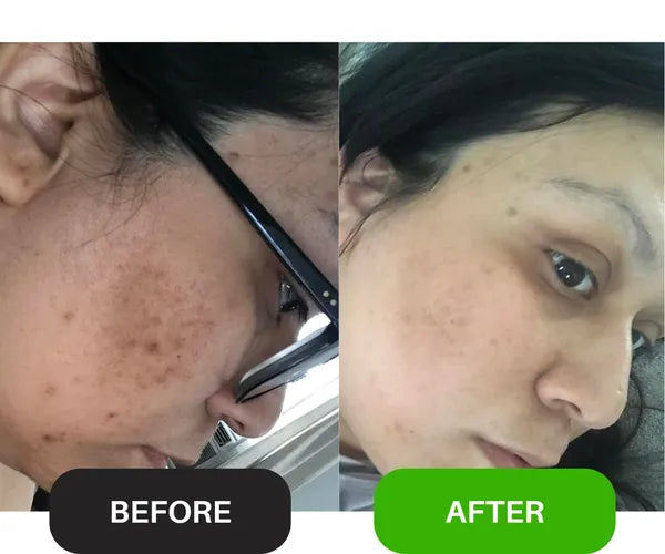 Before and after comparison of a person's face with visible skin improvement.